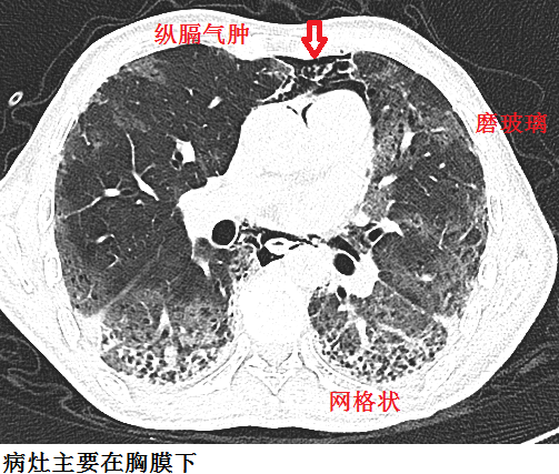 間質(zhì)性肺炎最新藥物研究突破與進展概述